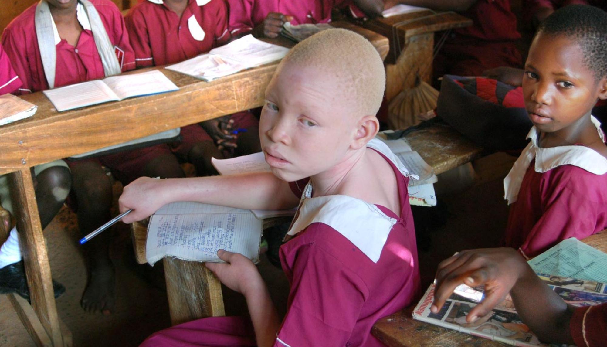 Uganda albinismo 1