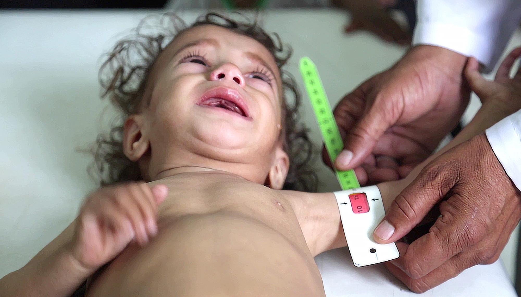 Yemen -malnutrición