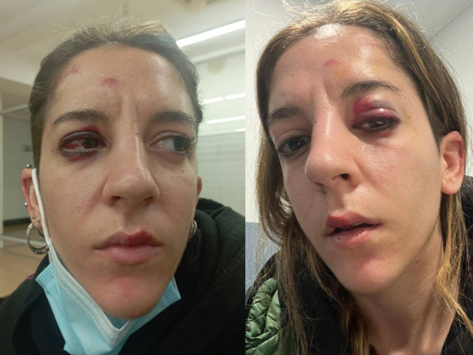 Joana Sales, militante del Sindicato de Vivienda del Raval, tras recibir una paliza durante una detención llevada a cabo por los Mossos d’Esquadra / Cedida