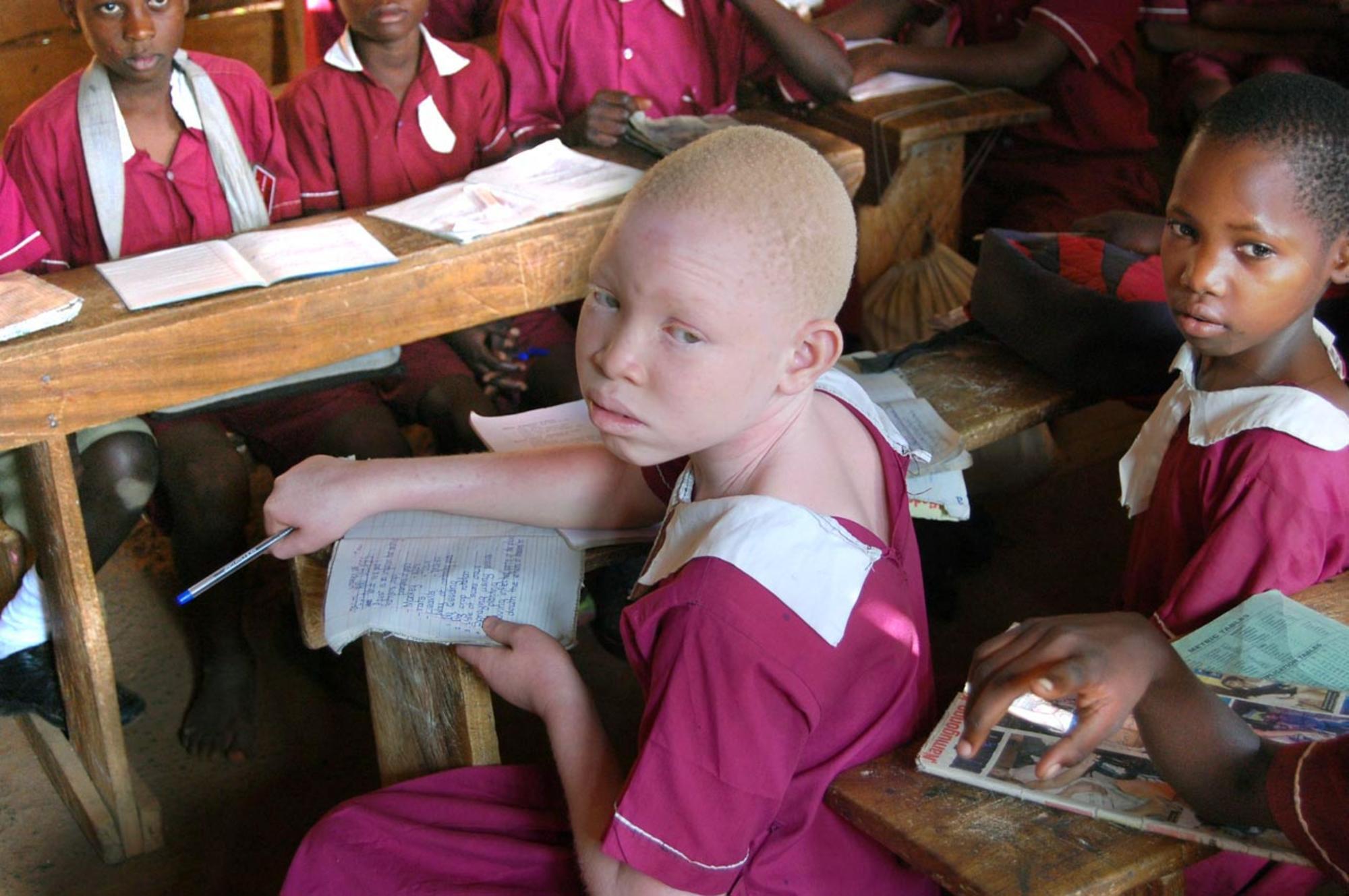 Uganda albinismo 1
