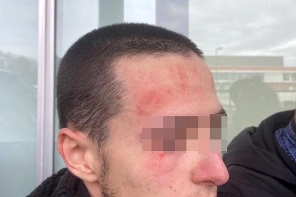 A student with marks of police repression on his face. Photo: El Salto.
