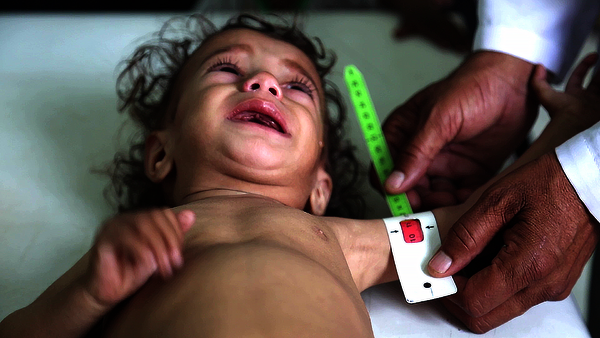 Yemen -malnutrición